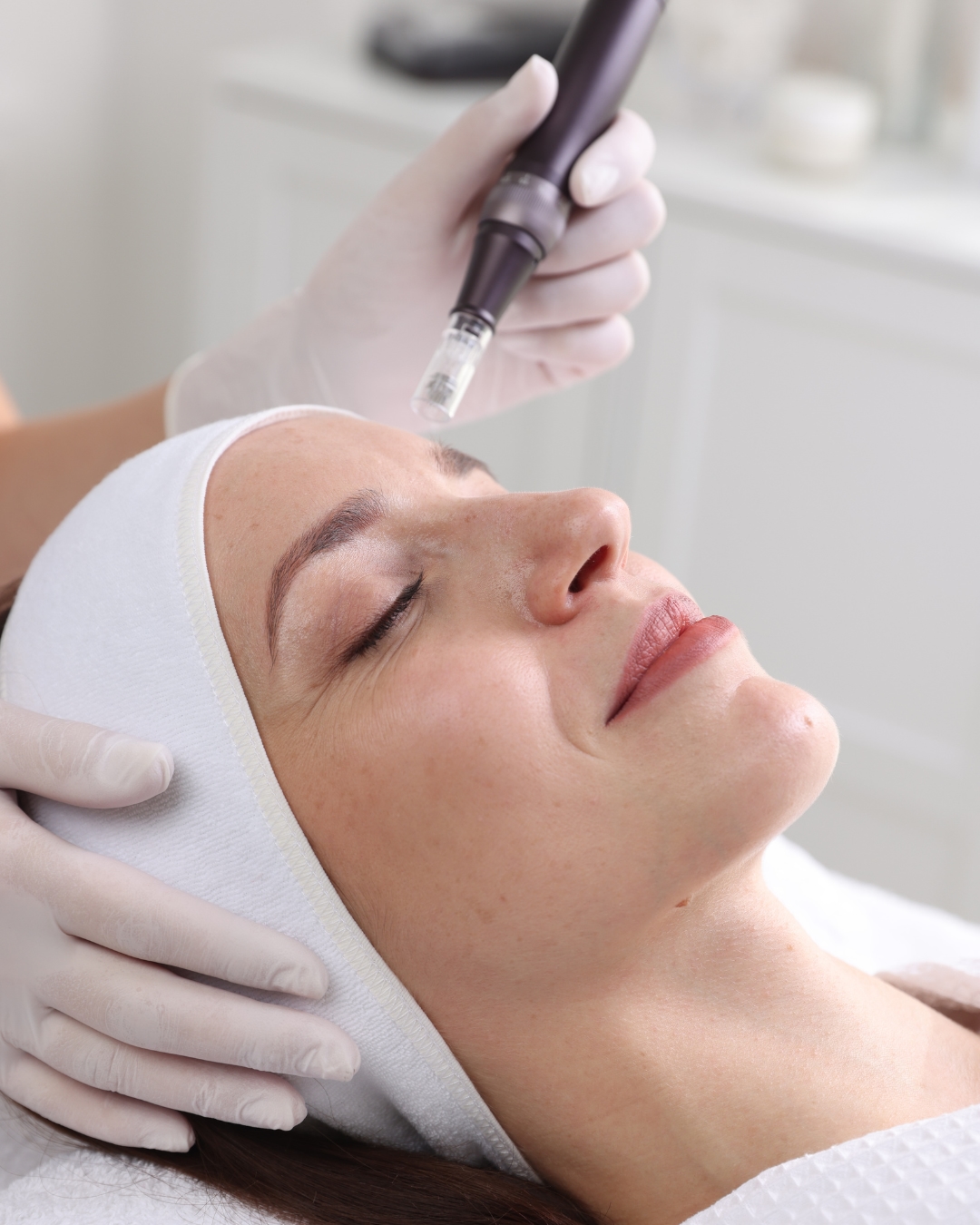 Microneedling